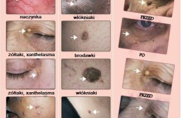 depilacja laserowa